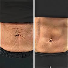 The cryo t shock is cryogenic and thermogenic treatment to remove cellulite and undesired fat. Cryo T Shock Glamour Academy