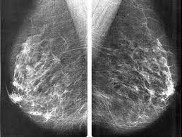 Mammographie Rontgenuntersuchung Der Brust