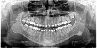 Image result for Gardner Sendromu