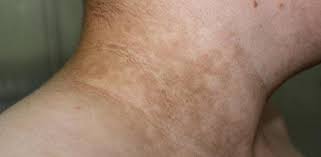 Acantosis Nigricans Sintomas Causas Y Como Tratar La Enfermedad
