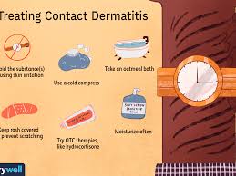Home remedies to treat skin allergies naturally. How Contact Dermatitis Is Treated