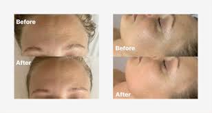 Manual lymphatic drainage encourages the movement of the lymphatic system, which reduces swelling and puffiness, induces relaxation, and improves the skin's tone and texture. Facial Massage And Jade Rollers Do They Actually Work Realself News