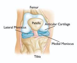 A meniscus tear is a common knee joint injury. Meniscal Transplant Surgery Orthoinfo Aaos