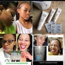 Don't buy before you read this. Noma Truimphant On Twitter Say Bye To Ance Black Spots Pimples And Blackheads Hello To Glowing Flawless And Radiant Skin With Herbalife Skin Care Product Herbalife Https T Co Tdq6xv6q0u