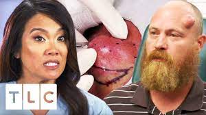 'it was awful, i didn't want to go outside': Dr Lee Squeezes An 18 Year Old Cyst Dr Pimple Popper Youtube