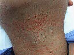 Purpura Vs Petechaie: Differences, Causes, And Treatments