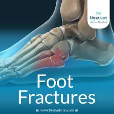 Image result for Foot Fracture