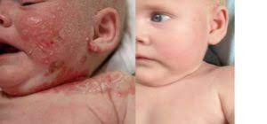 Check spelling or type a new query. Neurodermitis Beim Baby Erkennen Und Reagieren Autoimmunportal