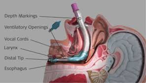 Image result for Extraglottic Device