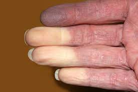 Raynaud S Disease Mydr Com Au