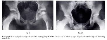 Image result for Perthes Test