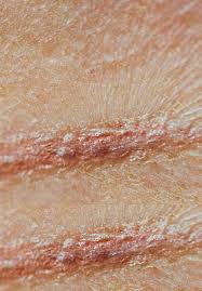 Treatment can usually be performed at home. Scarring After Burn Injury Intechopen