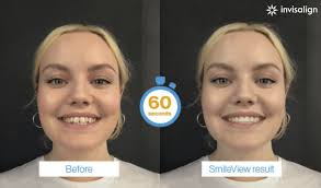 Invisible Braces in Sunbury-on-Thames