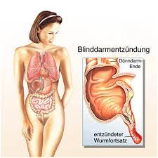 Blinddarmentzundung Blinddarmoperation Blinddarm Appendizitis Appendektomie