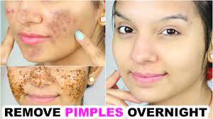 Remove Pimples Overnight | 100% Success | Anaysa - Youtube