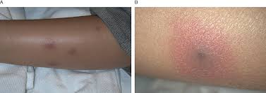 Image result for Panniculitis