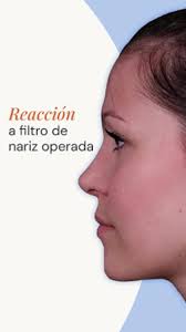 Reacción a filtro de nariz operada👃🏻, En el link de nuestra bio puedes  acceder al TEST gratuito para que puedas ver cómo quedaría tu nariz ideal.,  Si quieres que valoremos tu caso y te ofrezcamos la ...