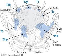 When cancer starts in the bladder, it is called bladder cancer. Bladder Cancer Men At Risk Harvard Health Publications Harvard Health