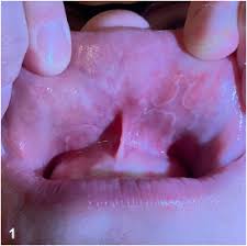 Image result for Labial mucosa