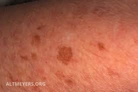 Fleck Dunkler Altmeyers Enzyklopadie Fachbereich Dermatologie