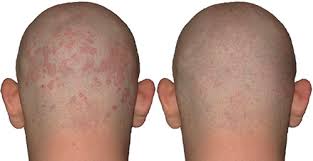 Per la cura della dermatite seborroica vi consigliamo di fare questo trattamento per il cuoio capelluto che si divide in due fasi Curare La Dermatite Seborroica Grandi Offerte
