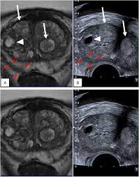 There is no single test to detect prostate cancer. Multiparametric Magnetic Resonance Imaging For The Detection Of Clinically Significant Prostate Cancer What Urologists Need To Know Part 3 Targeted Biopsy European Urology