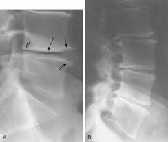 Lumbar Degenerative Disease Musculoskeletal Key