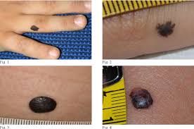 Image result for Spitz Nevus