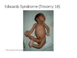 Many parts of the body are affected. Errors In Meiosis Preparing A Karyotype A Karyotype