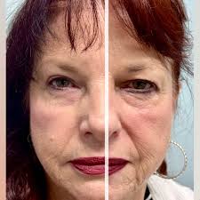 Pictured is my patient who was tired of looking and feeling tired from her  heavy upper lids and lower lid bags. She underwent upper and lower  blepharoplasty and is thrilled with how refreshed she ...