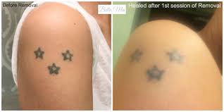 Make a thick paste by mixing lemon juice in about 100 grams of salt (6 teaspoons). Salt And Saline Tattoo Removal Picosure Tattoo Removal Tattoo Removal Cost Tattoo Removal