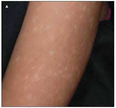 Image result for Postinflammatory Hypopigmentation