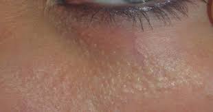 White Bumps Under The Eyes Called Milia And How To Get Rid Of Them Bumps Under Eyes Simple Skincare Undereye
