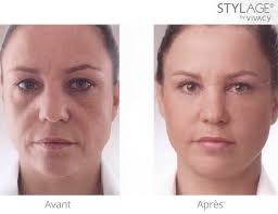 Epingle Par Soesthetic Sur Injections Visage Hyaluronique Acide Hyaluronique
