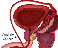 Psa is mostly found in semen, but a small amount is also found in blood. Simple Blood Test Can Detect Prostate Cancer With High Accuracy