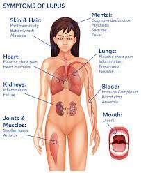 Maybe you would like to learn more about one of these? An Alternative Standard Of Care For Severe Lupus Disease