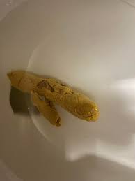 Image result for yellow stool human poop