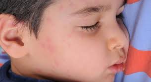 What do i do? answered by dr. Hives Ages 5 To 8 Babycenter