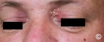 Image result for milium cyst on eyelid