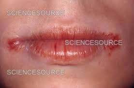 Image result for Angular Stomatitis