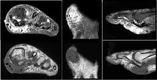 Chronic foot pain is a common and often disabling clinical complaint that can interfere with a patient's routine activities. Key Pearls On Diagnosing And Addressing Leiomyoma Of The Foot Podiatry Today