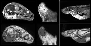 The intrinsic muscles of the foot are key contributors to foot function and are important to evaluate in lower limb disorders. Key Pearls On Diagnosing And Addressing Leiomyoma Of The Foot Podiatry Today