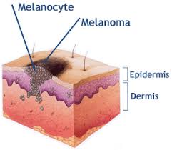 تحدث إلى طبيبك إذا لاحظت أي تغييرات في أظافرك. Ø§ÙÙÙÙØ§ÙÙÙØ§ Ø³Ø±Ø·Ø§Ù Ø§ÙØ®ÙØ§ÙØ§ Ø§ÙØµØ¨ØºÙØ© Melanoma Ø·Ø¨ÙØ¨ Ø¯ÙØª ÙÙÙ