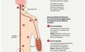 Les cas de maladie de charcot se répartissent de la façon suivante : Maladie De Charcot Sla Age Premiers Symptomes Cute766