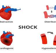 Cardiogenic Shock: A Comprehensive Overview - Longmore Clinic