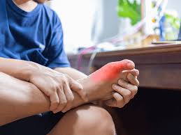 Image result for gout
