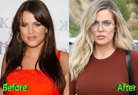 Khloe kardashian and plastic surgery. Khloe Kardashian Before And After Cosmetic Surgery Khloe Kardashian Plastic Surgery Kardashian Plastic Surgery Celebrity Plastic Surgery