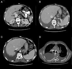 Image result for Intestinal Enteropathy