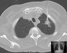 Maybe you would like to learn more about one of these? Biopsy Wikipedia