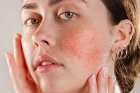 La rosácea es una condición de la piel. Suele comenzar por enrojecimiento  del rostro (nariz, mejillas o mentón). Se requiere un diagnóstico médico y  un tratamiento que ayude a controlarla. . #DermatologosOllague . . . . . .  . . . #